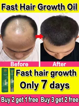 Масло за растеж на косата Бърз растеж на косата Ефективно възстановяване на плешивостта Наследствен косопад Следродилна загуба на коса Себореен косопад